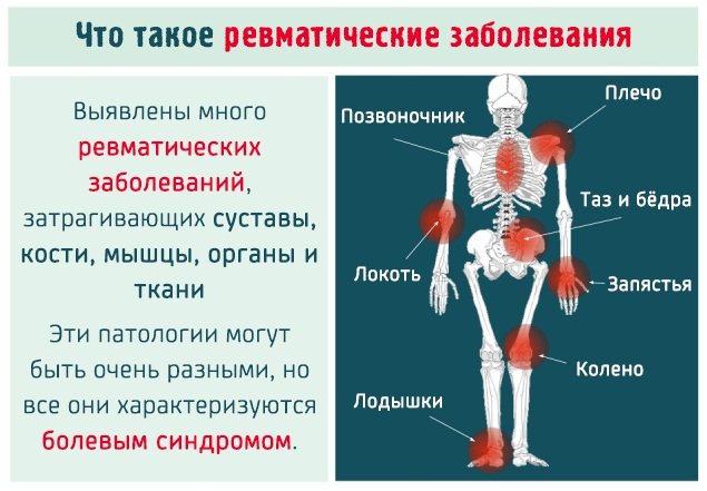 Ревматоидты артрит Емдеу (ревматизм) диета арқылы