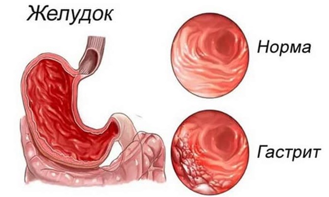 Гастрит с пониженной кислотностью