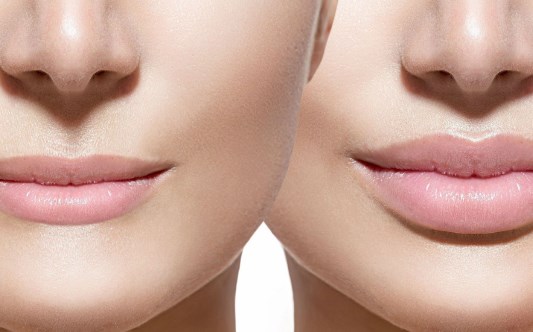 Lip augmentation with hyaluronic acid