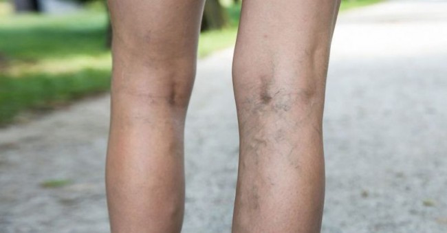 picioarele de intrare varicoza ce este o femeie varicoasa într-o femeie