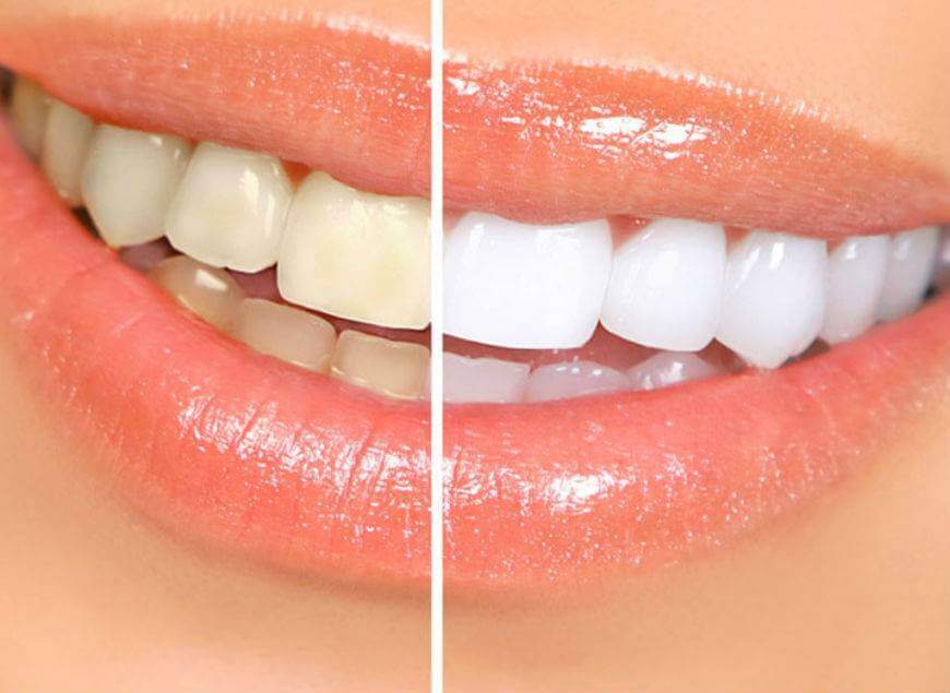 teeth whitening Zoom 4