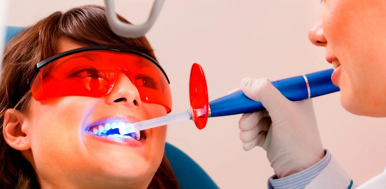 Отбеливание зубов дома или в стоматологии