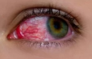 Туберкулезное поражение глаз