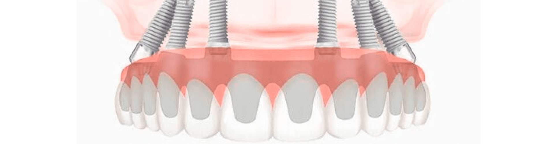 Dental implantation