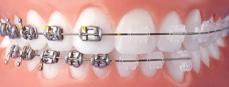 Брекеты и брекет-системы для зубов
