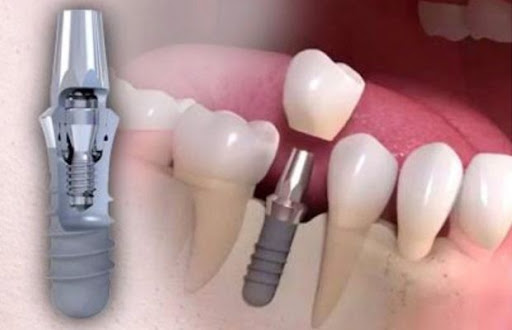 Зубные имплантаты Straumann конструкция