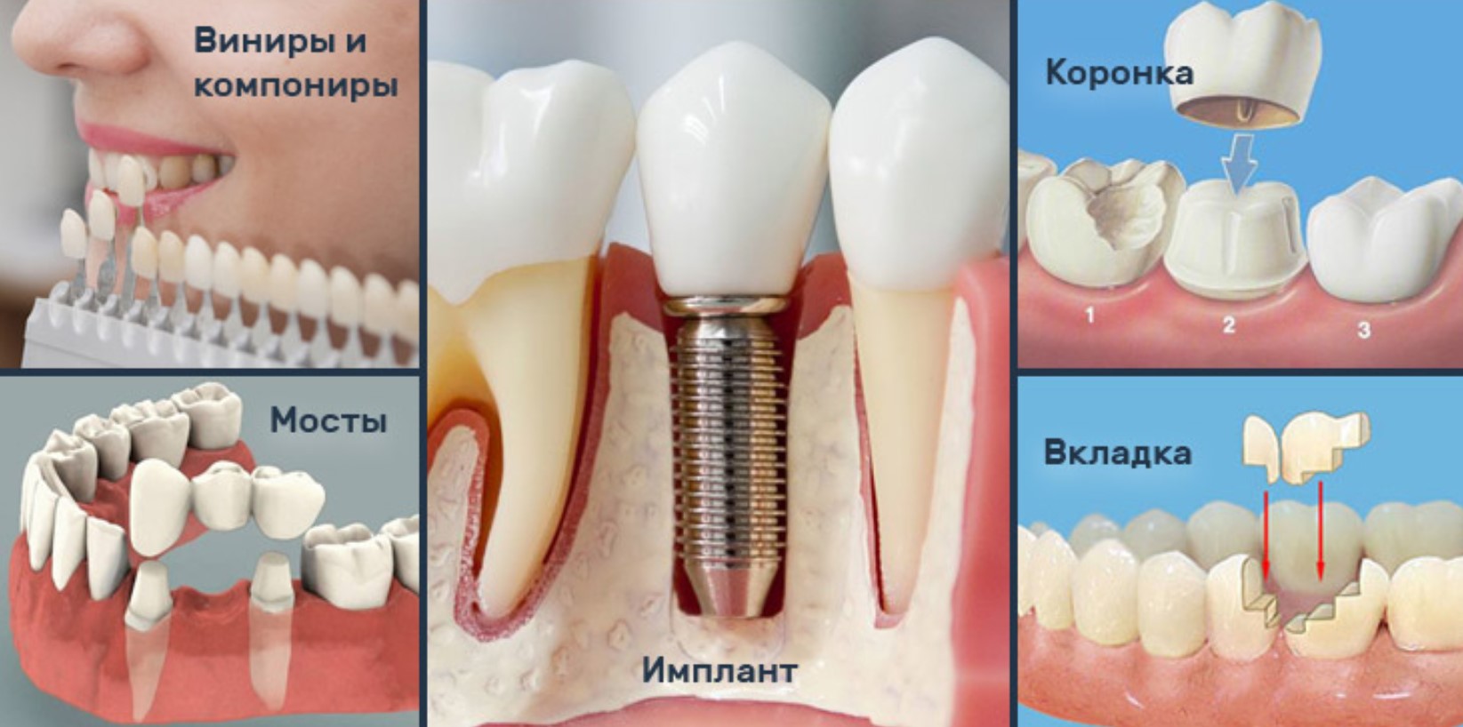 Імплантації зубів у стоматології «SmileSymphony»