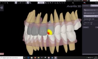 ПО для 3D моделирования зубов Avantis 3D.