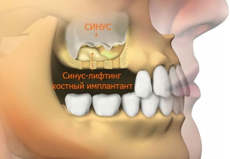 більшість пацієнтів під час розгляду питання імплантації зубів лякаються переважно