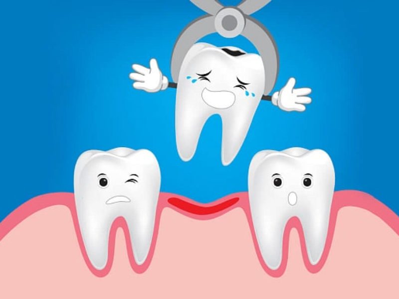 Видалення зубів