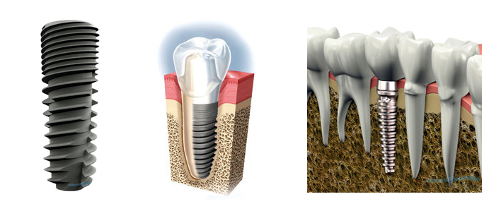 імплантацыя зубоў