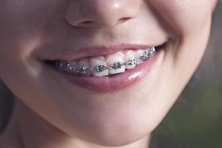 What braces should be given to a teenager to correct his bite?